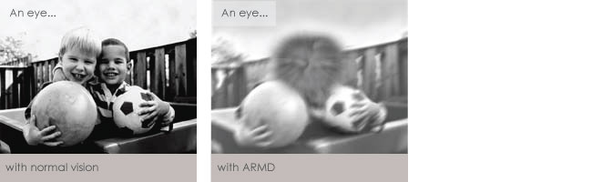 ARMD