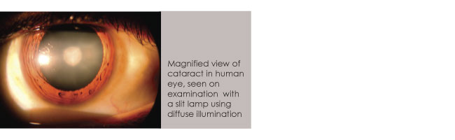 Cataracts