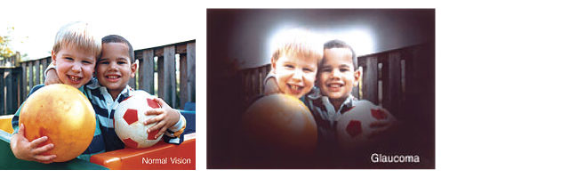 Glaucoma