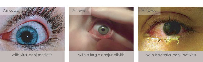 Conjunctivitis